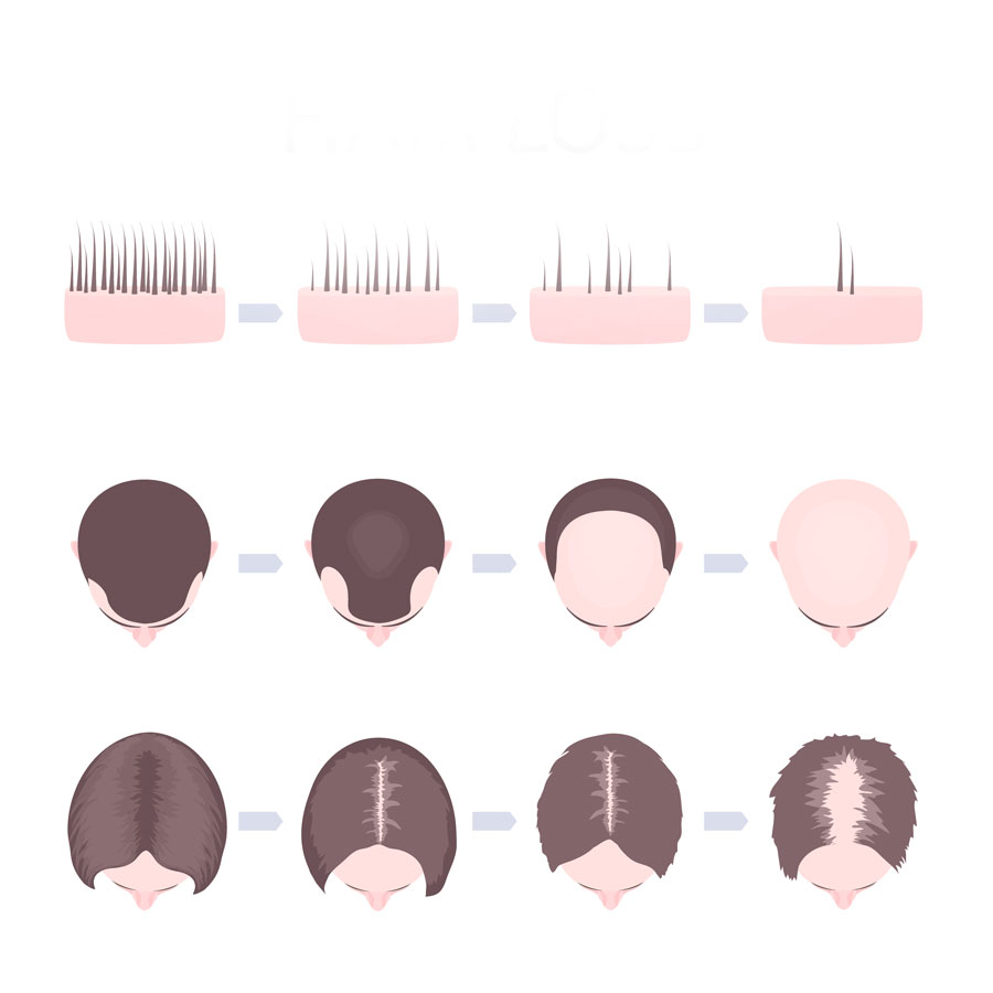 Typy łysienia