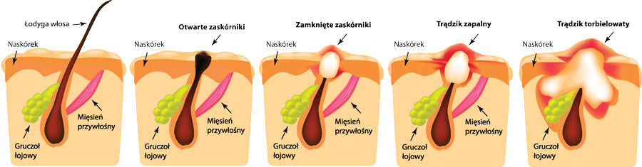 Cera tradzikowa rodzaje tradziku